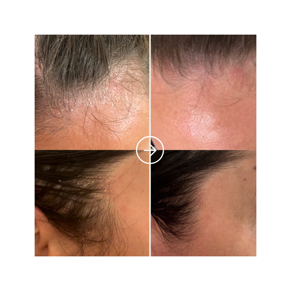 Pure Scalp Relief